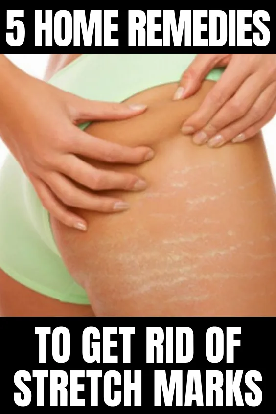 How To Get Rid Of Stretch Marks On Hips - Type and Seek -   17 how to get rid of stretch marks ideas