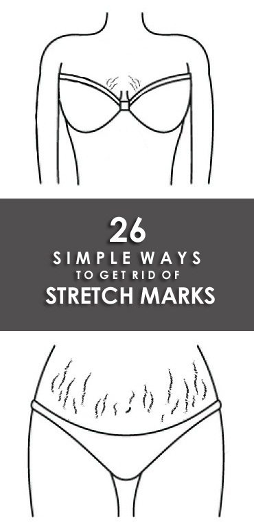 How to Get Rid of Stretch Marks Fast and Naturally? | Styles At Life -   17 how to get rid of stretch marks ideas