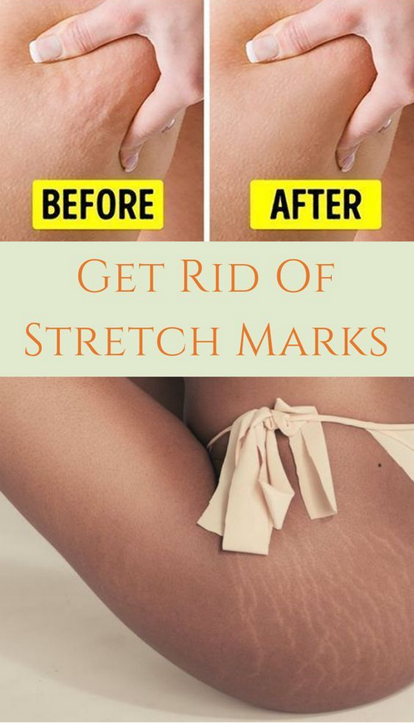 Acne Cream Stretch Marks Treatment -   17 how to get rid of stretch marks ideas