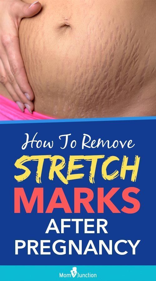 How To Remove Stretch Marks After Pregnancy: 16 Home Remedies -   17 how to get rid of stretch marks ideas