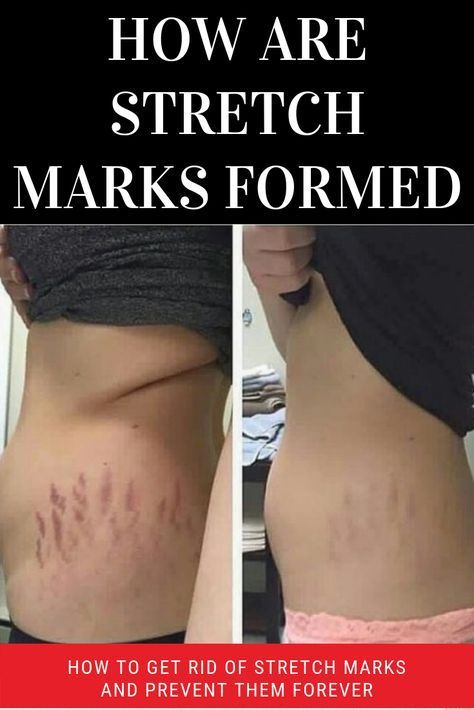 How To Get Rid Of Stretch Marks And Prevent Them Forever | Herbalfoo -   17 how to get rid of stretch marks ideas