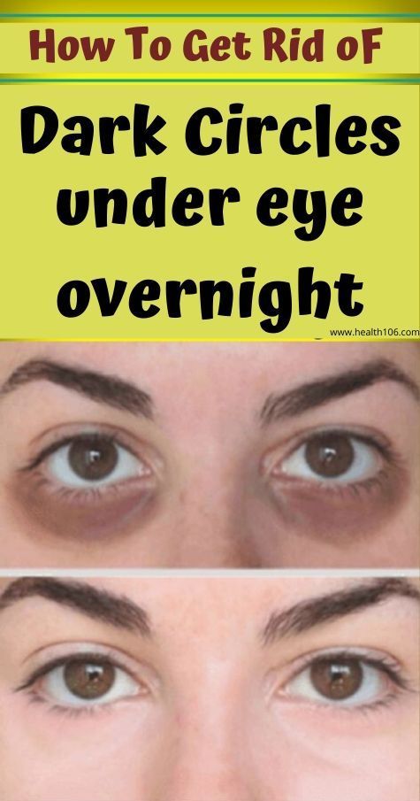 How to get rid of dark circles under eyes overnight -   18 how to get rid of dark circles under eye ideas