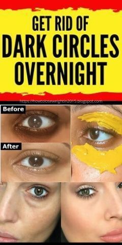 How To Get Rid Of Dark Circles Under Eyes Overnight -   18 how to get rid of dark circles under eye ideas