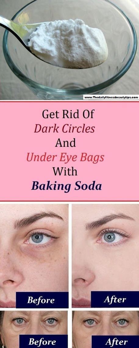 How To Get Rid Of Dark Circles & Under Eye Bags With Baking Soda? -   18 how to get rid of dark circles under eye ideas