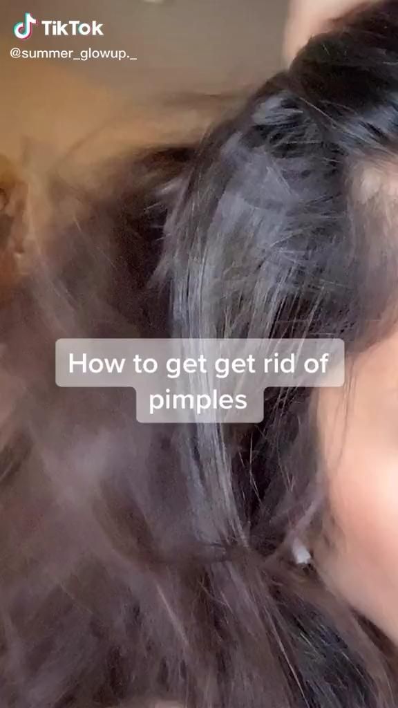 Simple Way to Get rid of Pimples рџ¦‹ -   19 how to get rid of pimples ideas