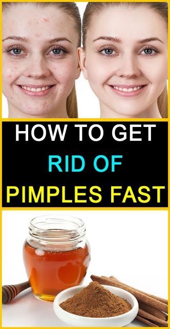 How To Get Rid of Pimples Fast -   19 how to get rid of pimples ideas