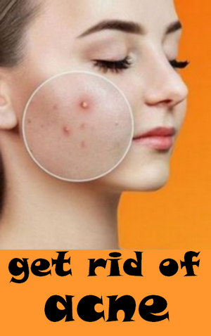 How To Get Rid Of Pimples (Acne) -   19 how to get rid of pimples ideas