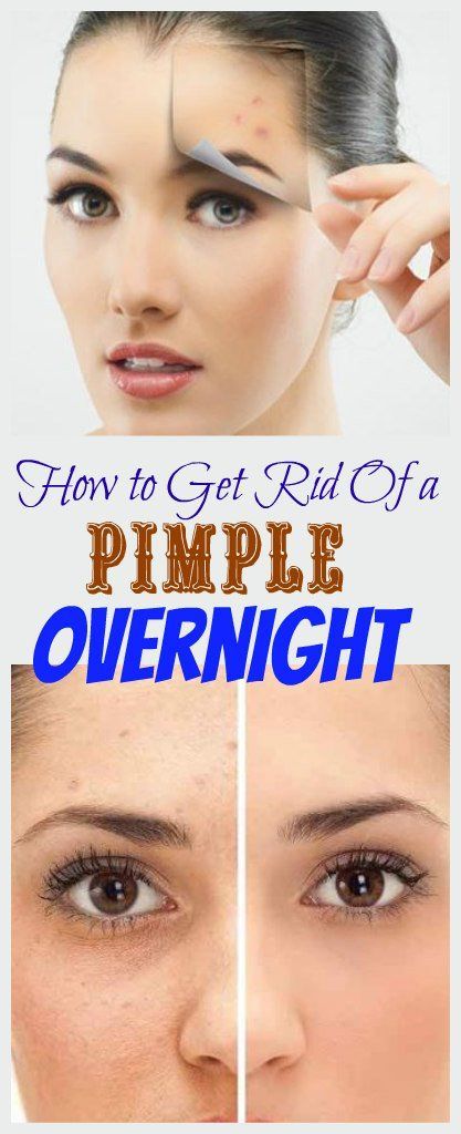 How to Get Rid Of a Pimple Overnight -   19 how to get rid of pimples ideas