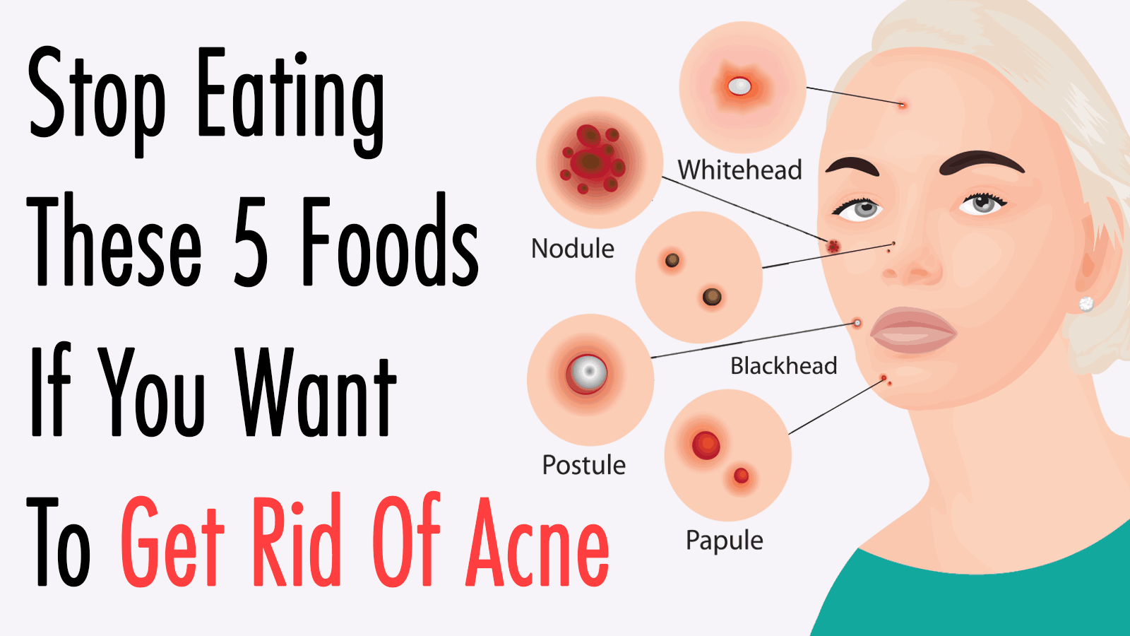 5 Foods to Never Eat If You Have Acne -   19 how to get rid of pimples ideas