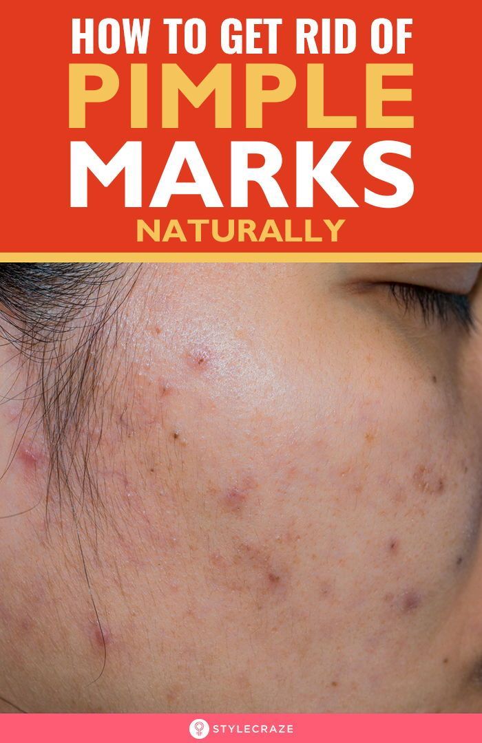 How To Get Rid Of Pimple Marks Naturally -   19 how to get rid of pimples ideas