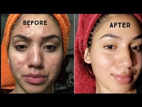 How to remove acne scars from face naturally | how to get rid of pimples | how to remove acne marks -   19 how to get rid of pimples ideas