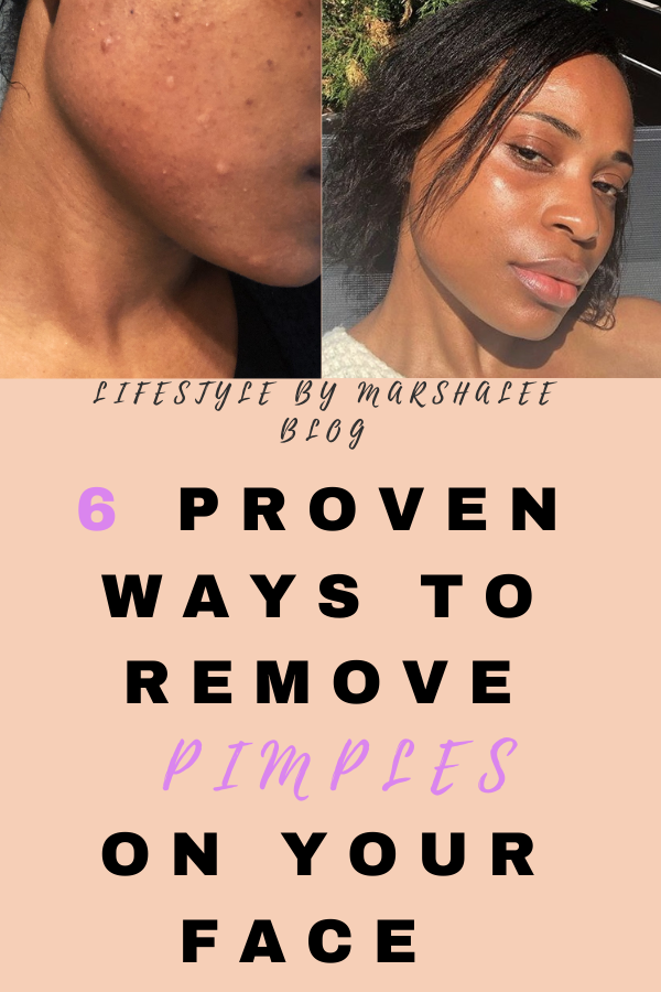 6 Proven ways to remove pimples on your face -   19 how to get rid of pimples ideas