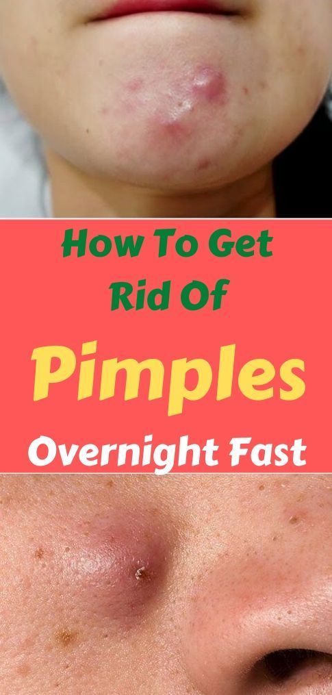 How To Get Rid of a Pimple Overnight Fast -   19 how to get rid of pimples ideas